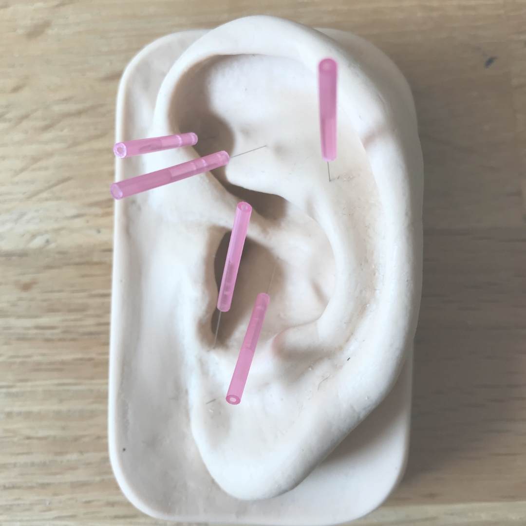 Ohrakupunktur Ausbildung